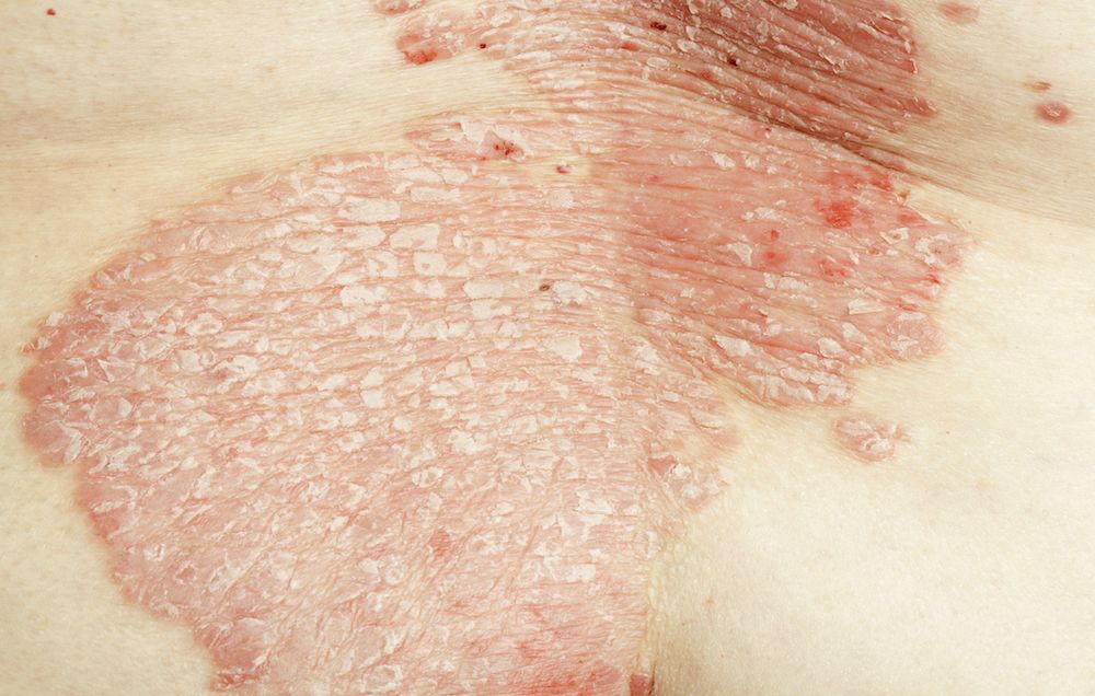 15 Natural Alternatives To Tackle Psoriasis For Good