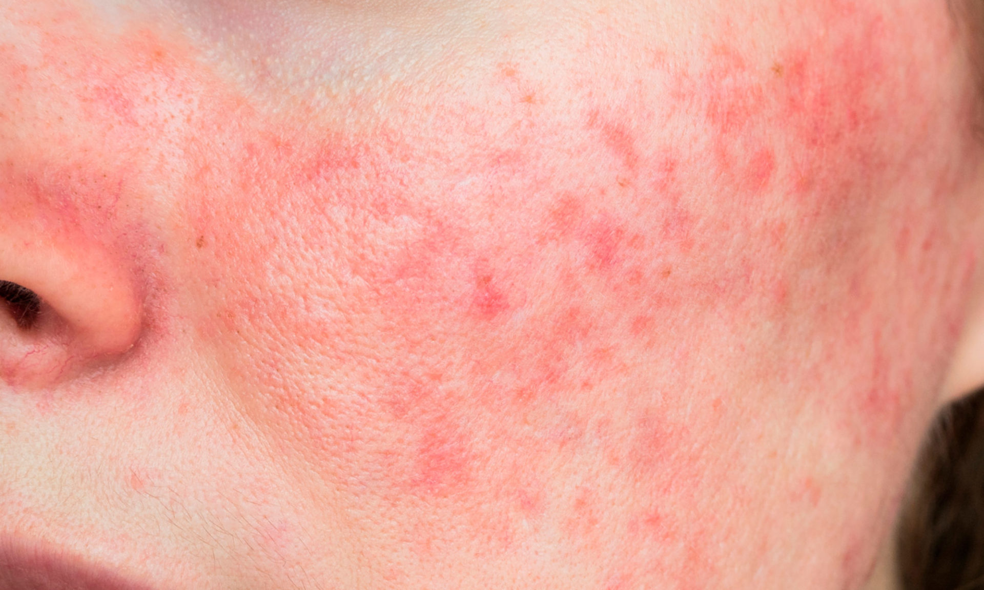 7 Natural And Definitive Ways To Deal With Rosacea