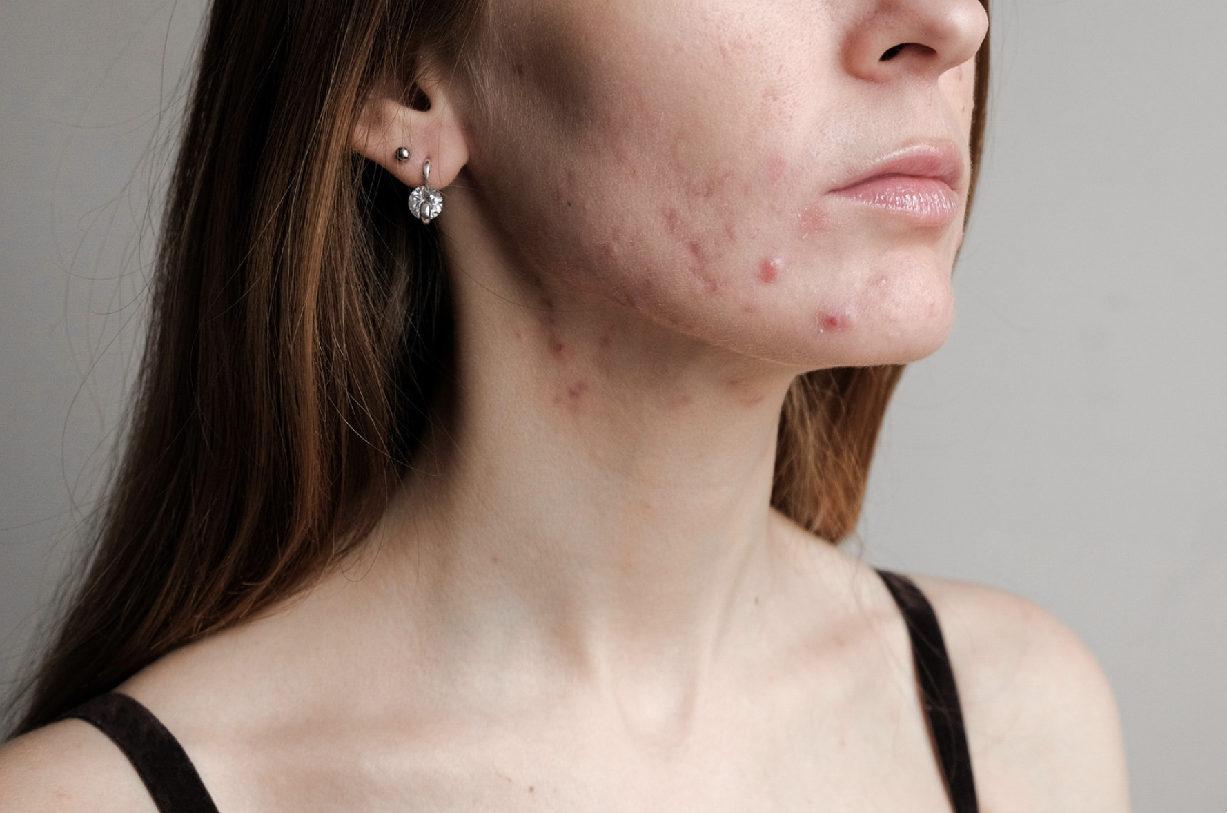 Best Foods And Herbs To Clear Hormonal Acne Now!