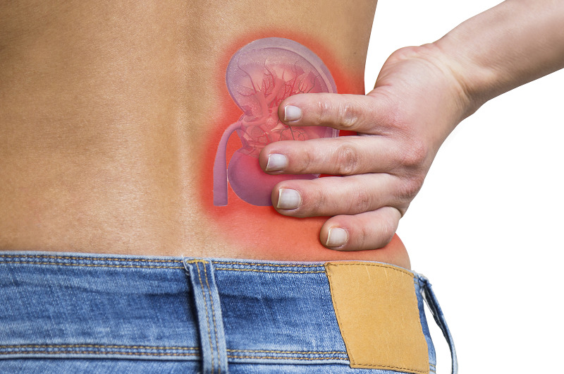 The Best Home Remedies To Flush Out Kidney Stones