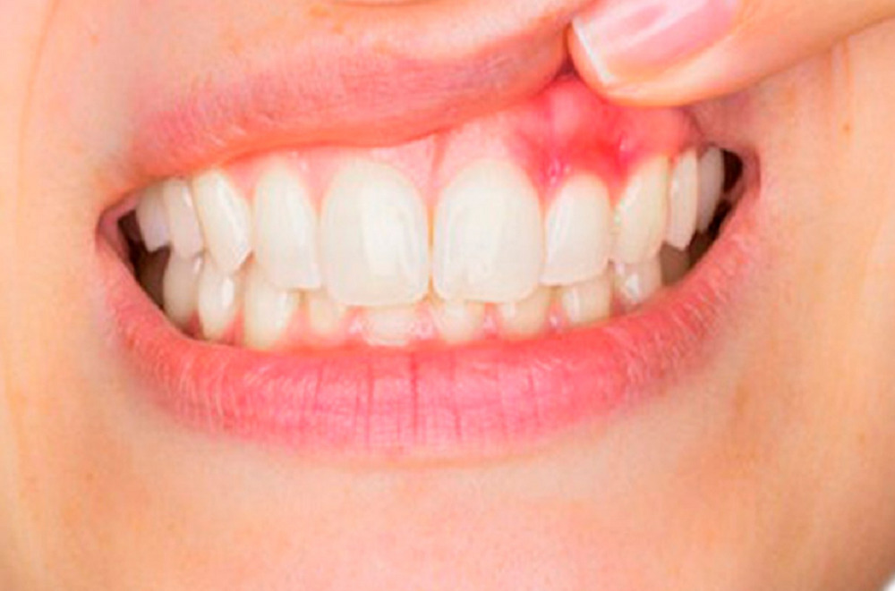 How To Fight Gum Disease With The Best Herbal Remedies