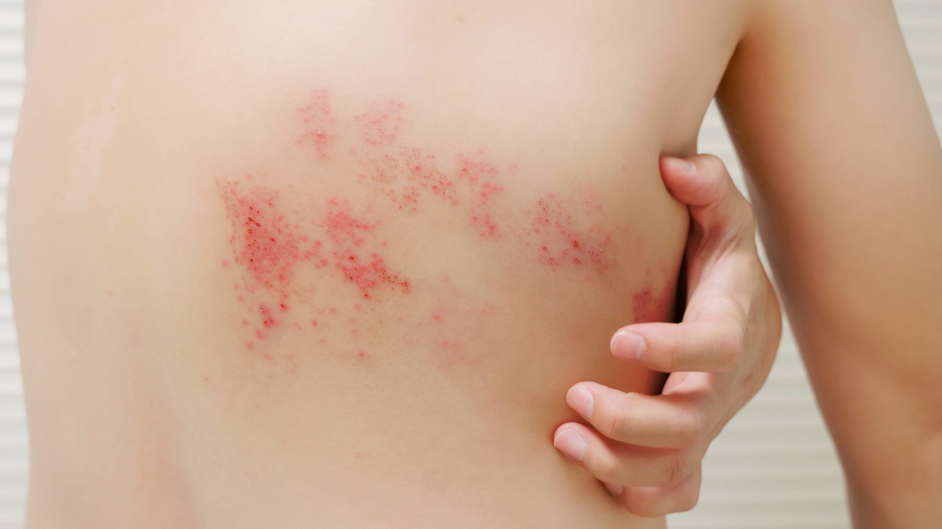 9 Remarkable Natural Treatment Methods For Shingles Relief
