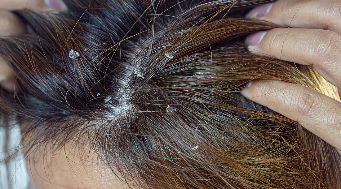 10 Home Remedies To Get Rid Of Dandruff
