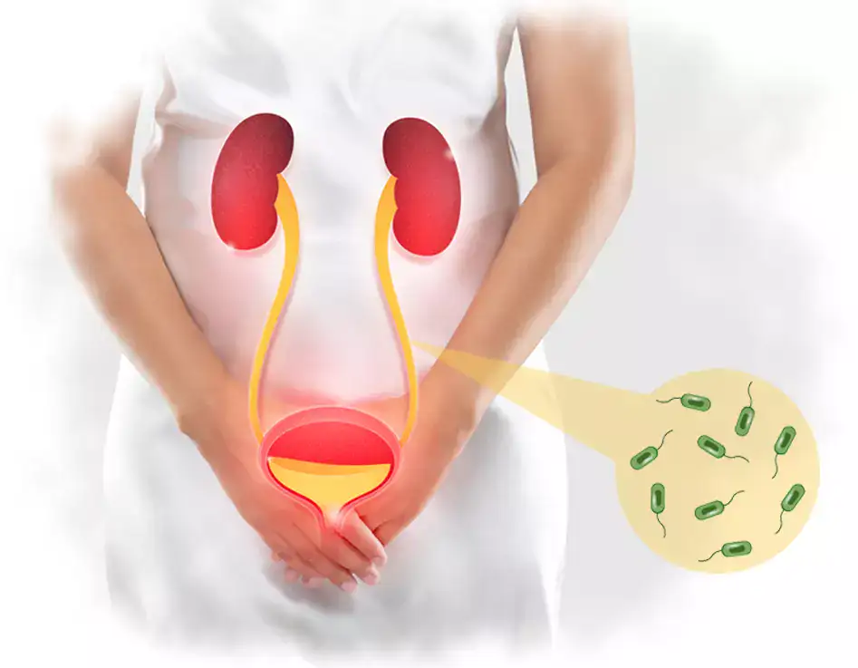 How to Treat Cystitis Naturally: Remedies & Prevention